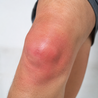 Inflamación Articular